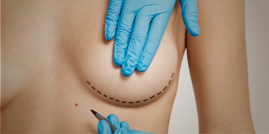 Prótese de Mama Dual Plane